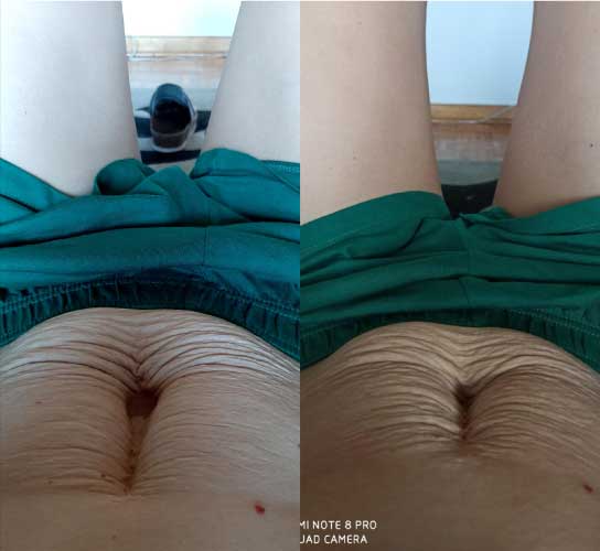 Slika žene prije i poslije poroda i našeg programa za dijastazu